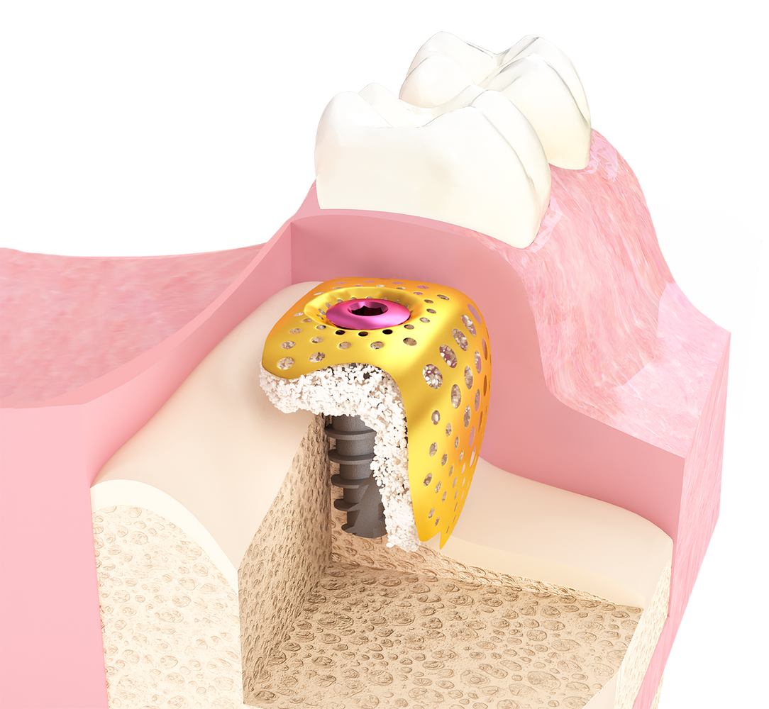 Bone substitution