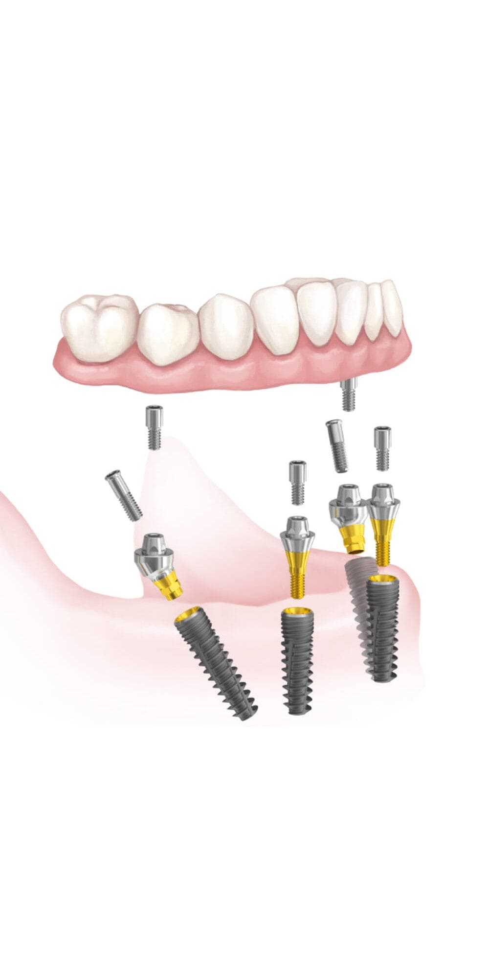 Package offer for Scandrea all-on-4® solutions