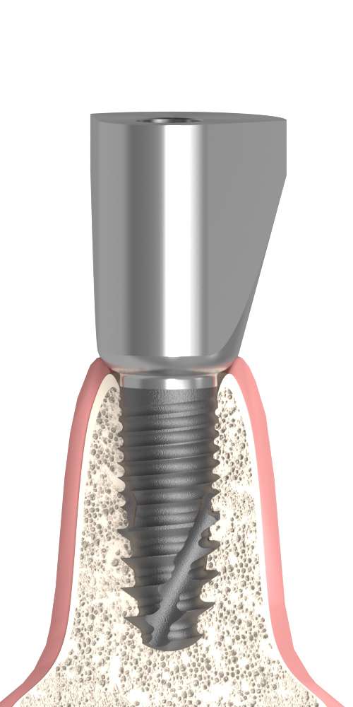 BIONIKA BB, Delta abutment, positioned