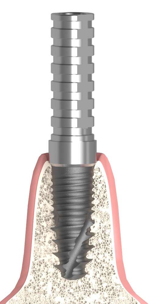 BIONIKA AS, Temporary abutment, implant level, positioned