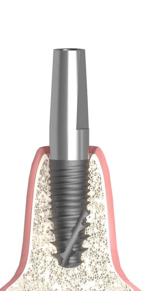 BIONIKA AG, Narrow abutment, straight, positioned