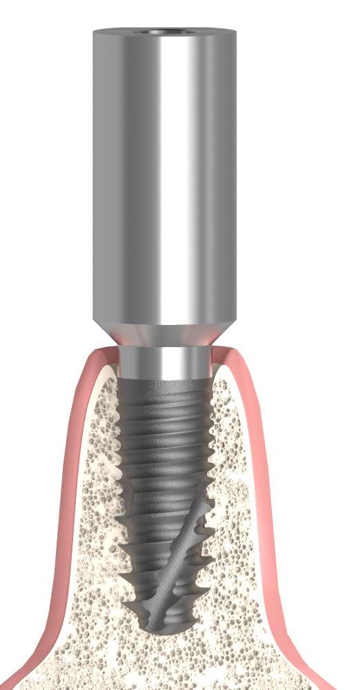 BIONIKA BIOLEVEL, Scanbody, screw-retained, positioned