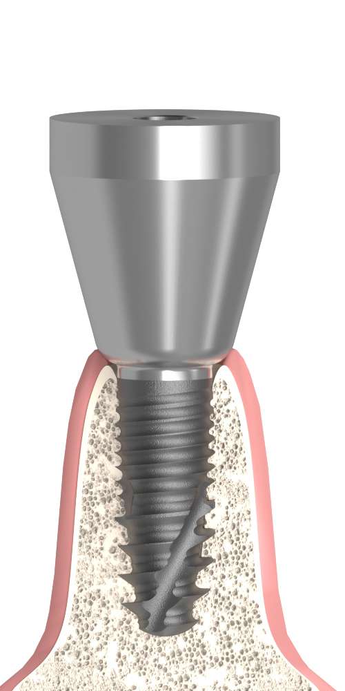 BIONIKA DENTUM, Trapezoidal abutment, positioned