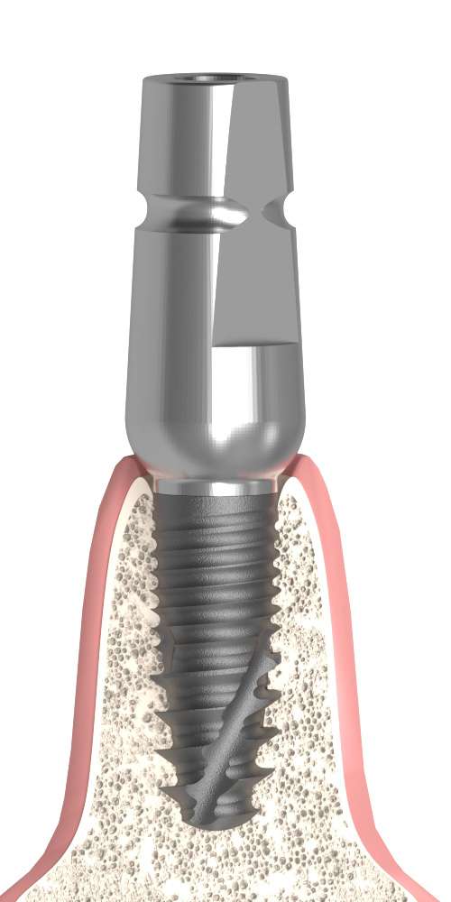 BIONIKA ST, Universal abutment, straight, IC, positioned