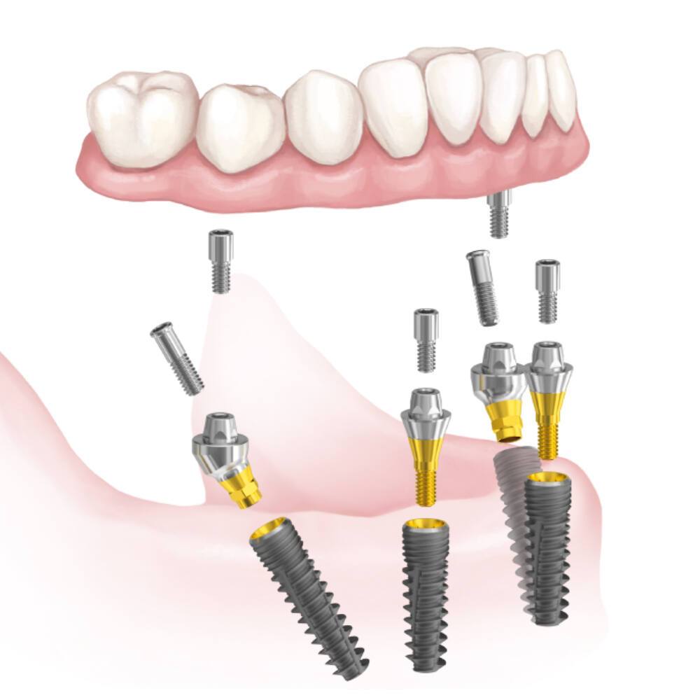 Package offer for Scandrea all-on-4® solutions