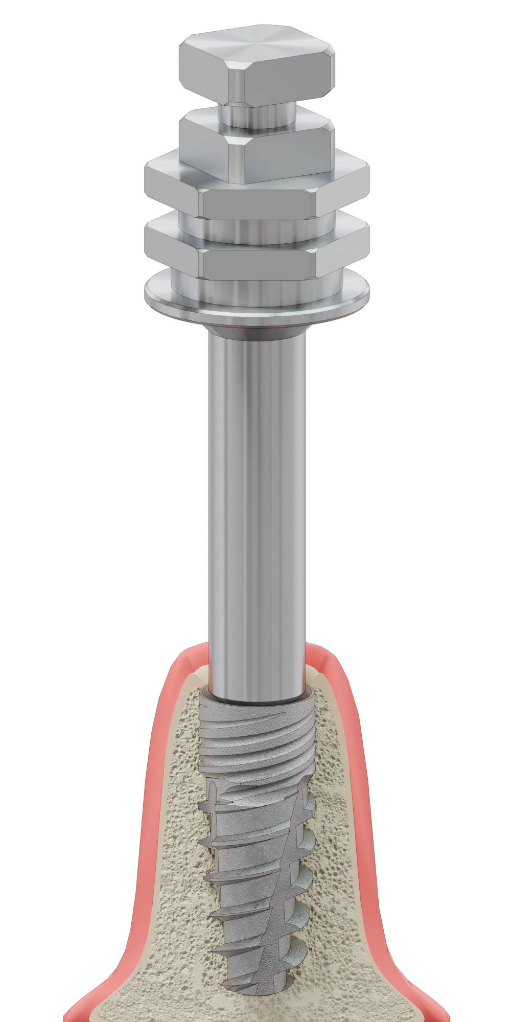 BIONIKA BIOPLANT, Implant driver, manual, lamellar, AB