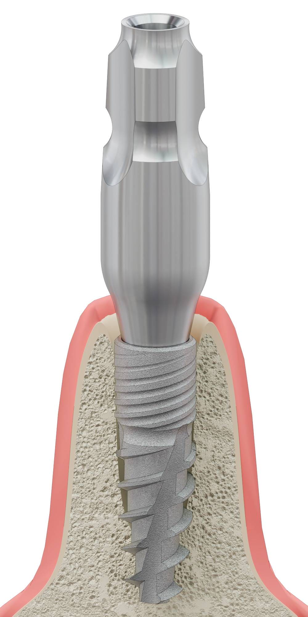BIONIKA CX, Impression coping for closed tray, uniform, positioned