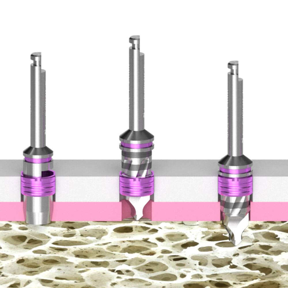 Implant Guide System