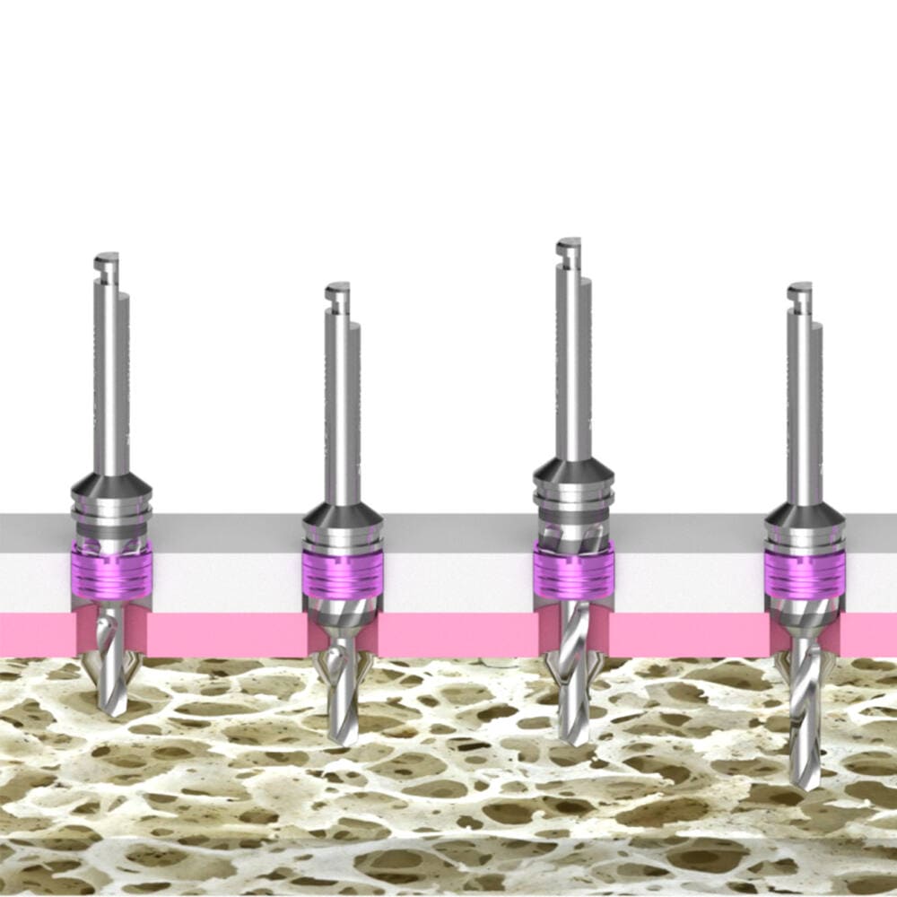 Implant Guide System