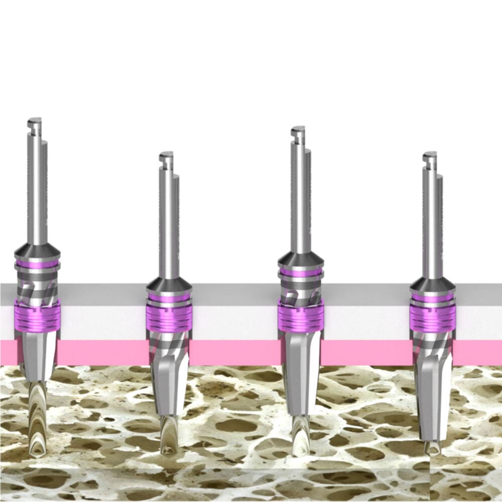 Implant Guide System
