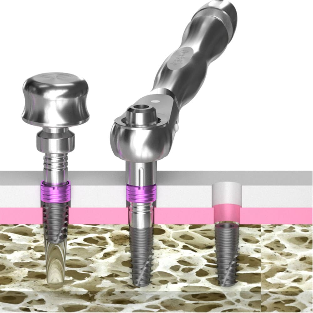 Implant Guide System