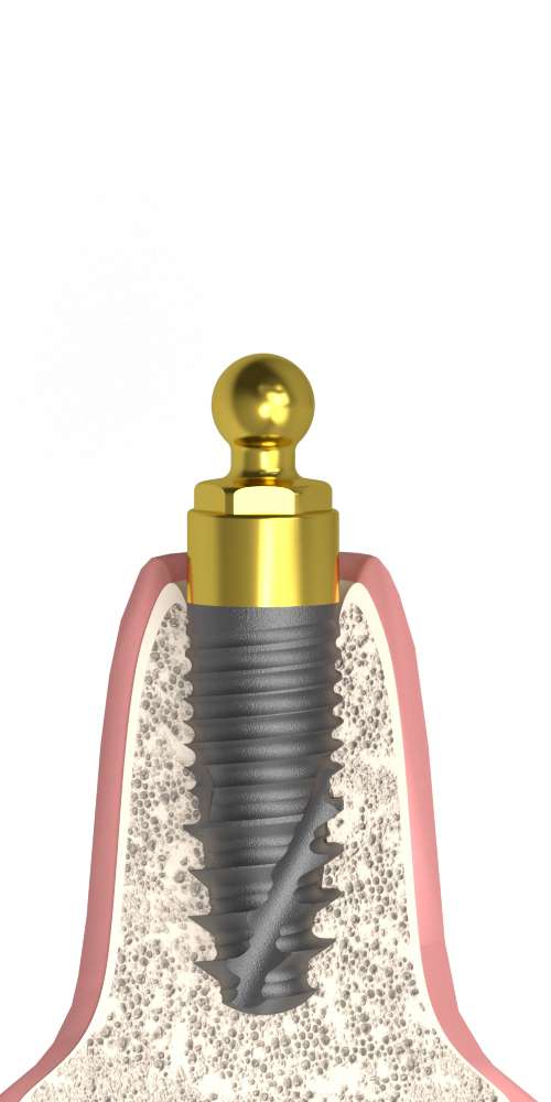 UNIFORM Straumann® Sin Octa® (ST) Compatible, Ball abutment