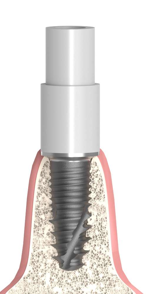UNIFORM Anthogyr® Axiom® (AG) Compatible, Multi-unit SR abutment plastic cap with titan base, positioned