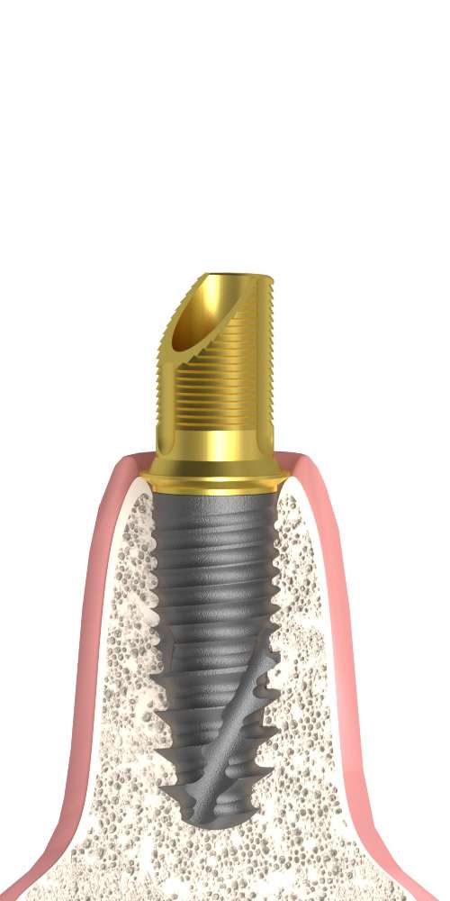 Osstem® (OS) Compatible, Pressed ceramic base, implant level, positioned