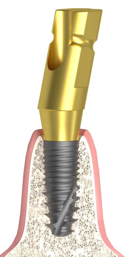 UNIFORM DenTi® Bonelevel® (DT2) Compatible, Impression coping for closed tray, angle