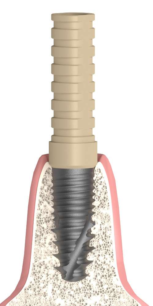 Dentium® Superline (DM) Compatible, Temporary abutment, implant level, PEEK