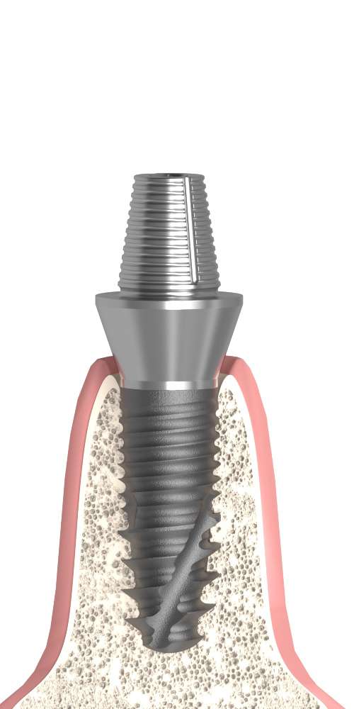 PerioType® (PT) Compatible, Temporary abutment, screwable