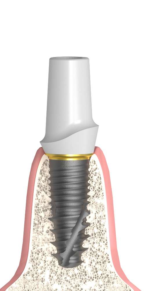 Osstem® (OS) Compatible, Zircon abutment, with titanium base, straight, positioned