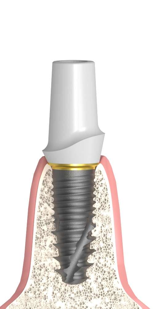 UNIFORM Anthogyr® Axiom® (AG) Compatible, Zircon abutment, with titanium base, straight, positioned