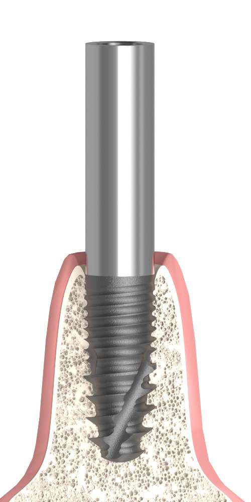 BIONIKA T-REX, Cylindrical abutment, straight, positioned