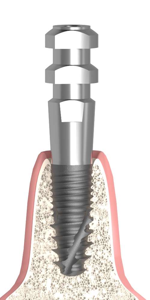 BIOPLANT, Impression coping for open tray, uniform, non-positioned