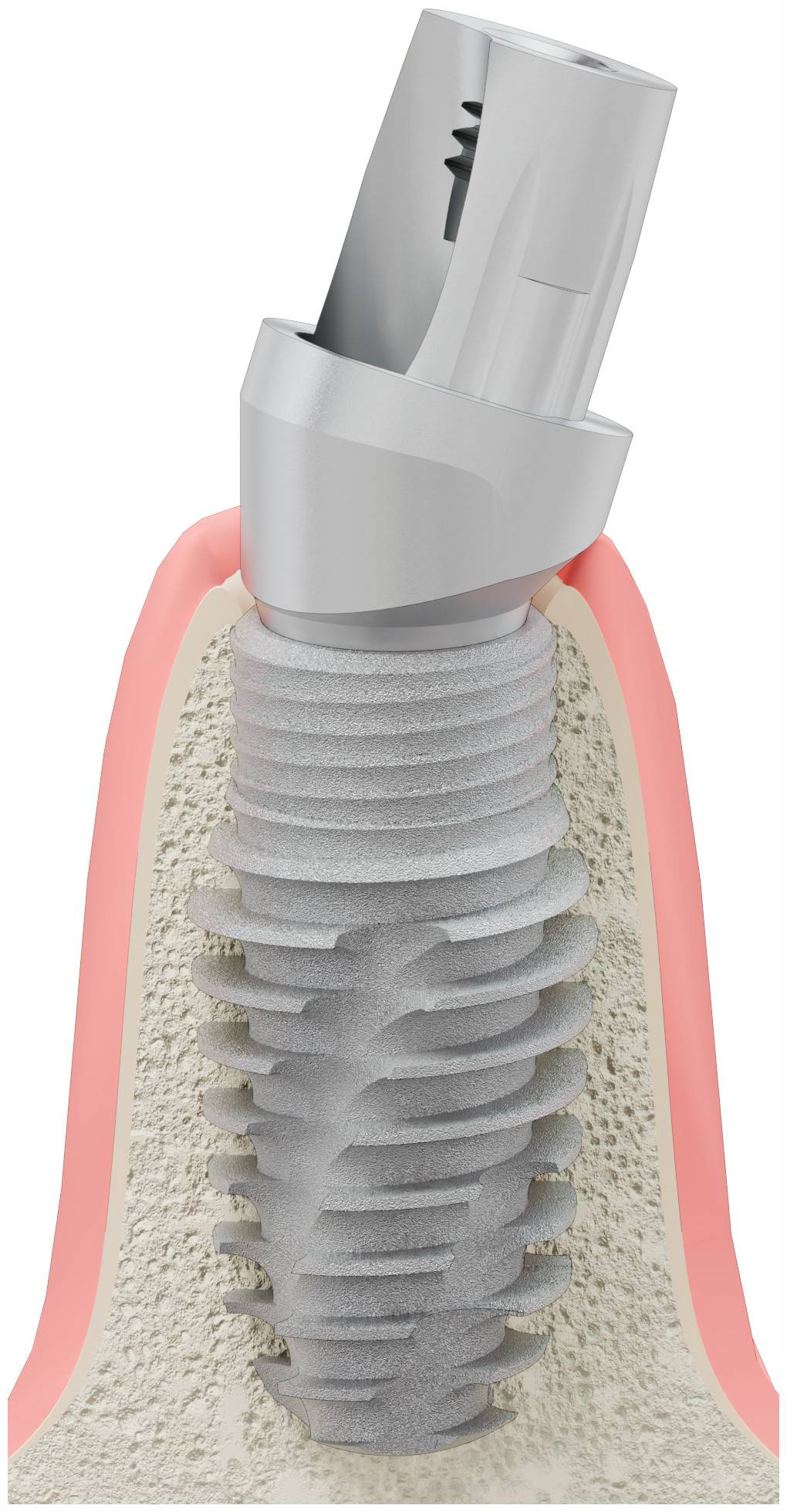 BIOPLANT, Titanium base, angled, positioned, type-A