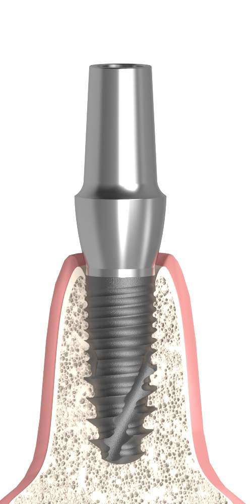 Implie, Anatomical abutment, straight