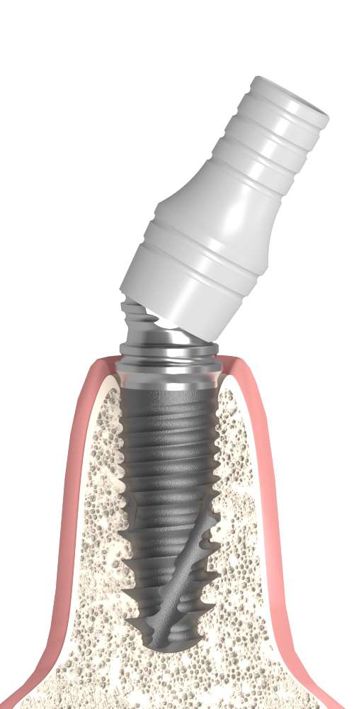 BIONIKA Bonelit Ball-joint abutment