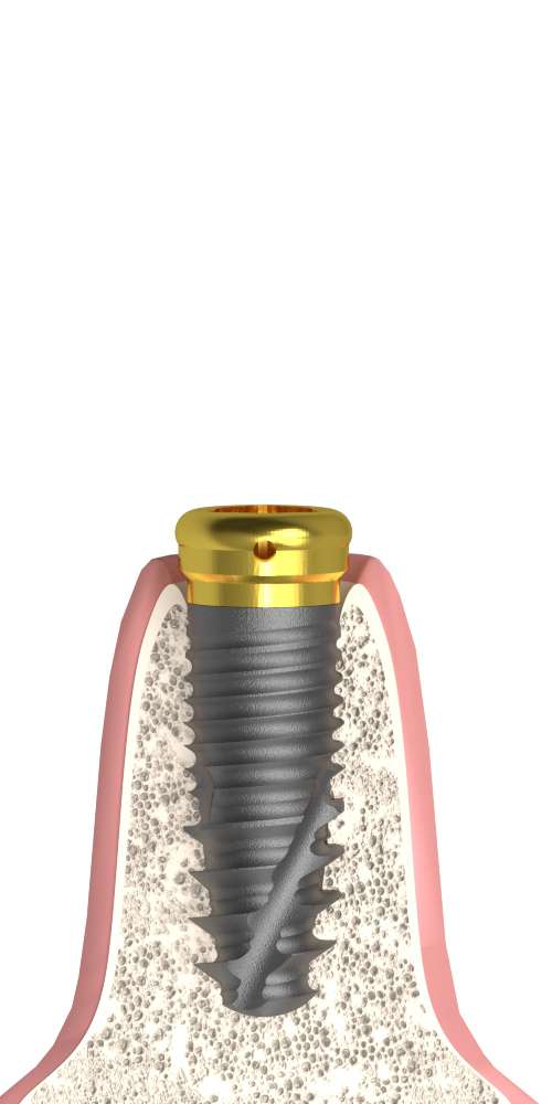 Bioplant, Locator abutment + cap set