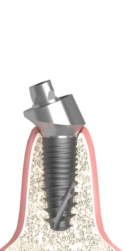 Implie, Multi-unit abutment, screw retained, angled