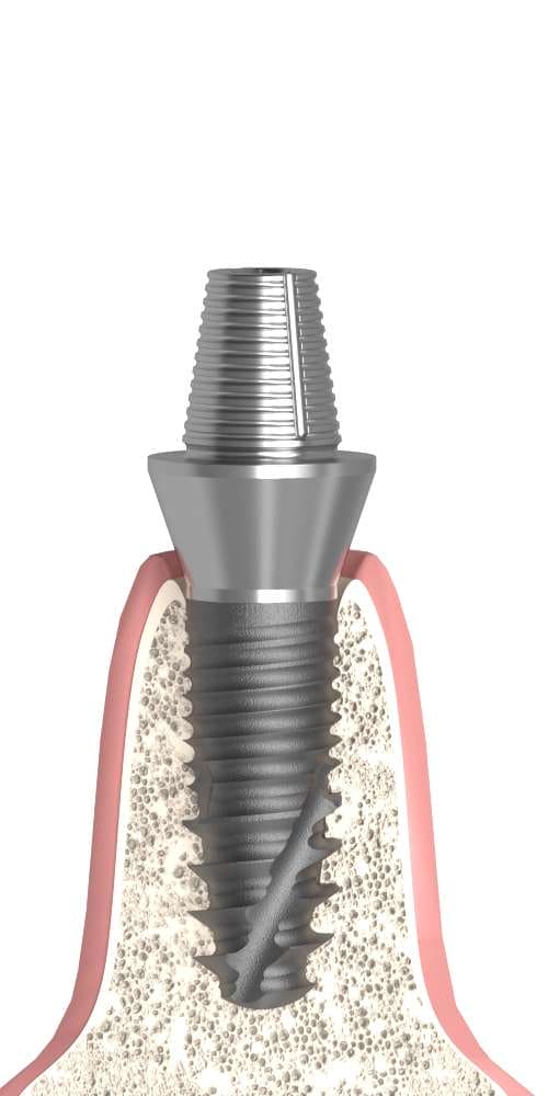 Corticon, Temporary abutment, screwable