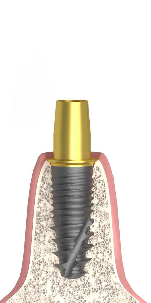 Corticon, Titanium base, implant level, positioned