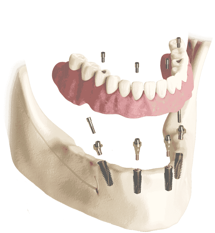 Package offer for all-on-4® solutions implant with abutmets
