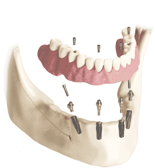 Package offer for all-on-4® solutions implant with abutmets