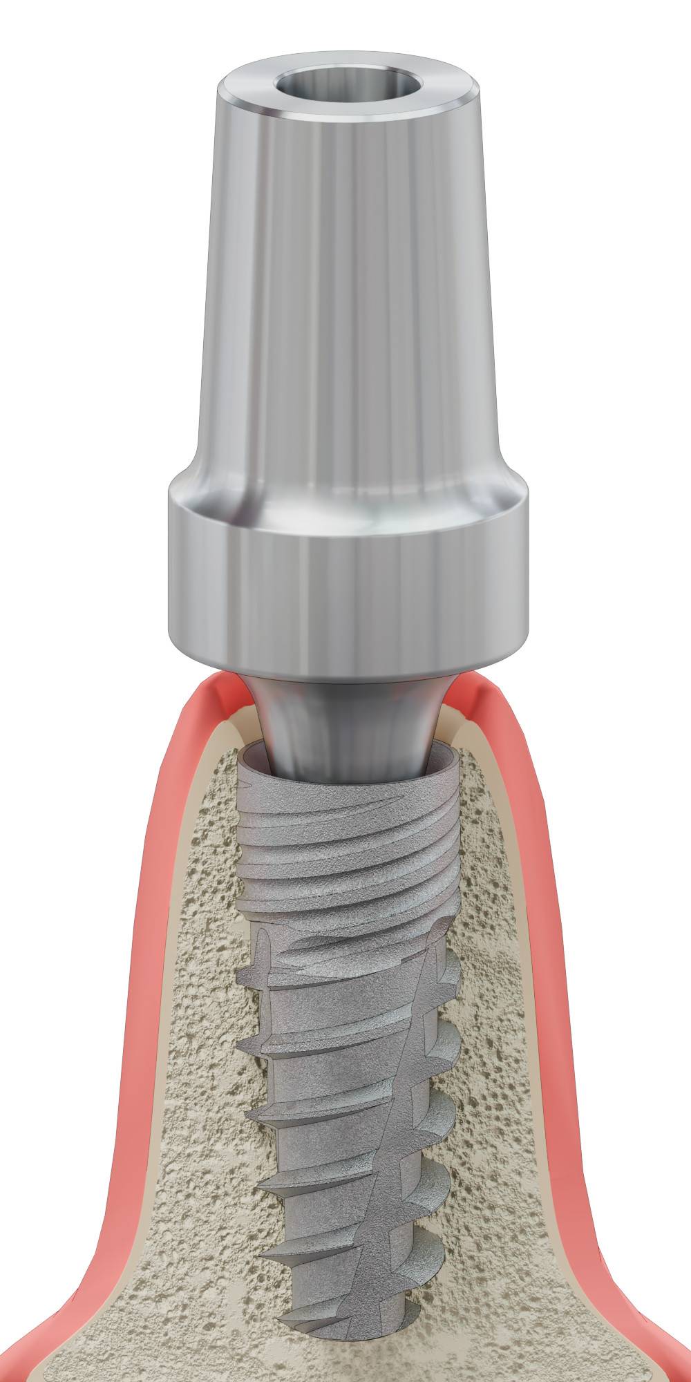 BIONIKA BIOPLANT, Anatomic abutment, straight, wide, positioned