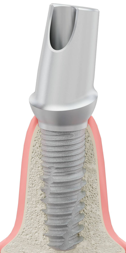BIOPLANT, Anatomic abutment, angled, 15°, positioned, type-A