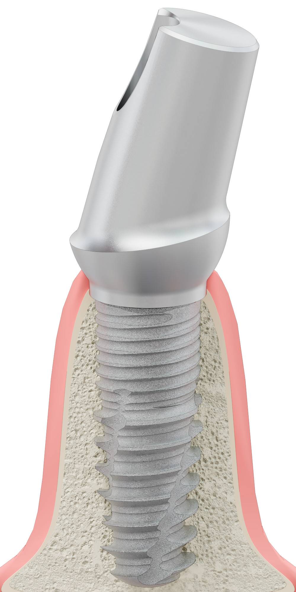 BIOPLANT, Anatomic abutment, angled, 15°, positioned, type-B