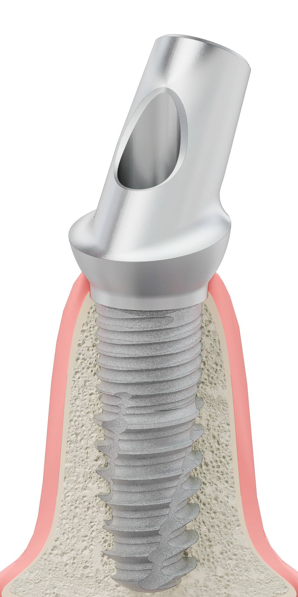 BIOPLANT, Anatomic abutment, angled, 35°, positioned, type-A