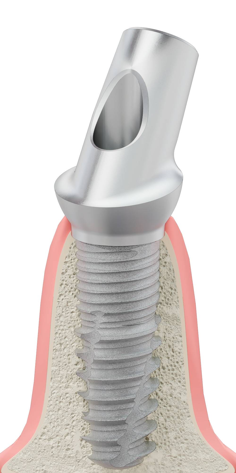 BIONIKA DI UF, Anatomic abutment, angled, 35°, positioned, type-A