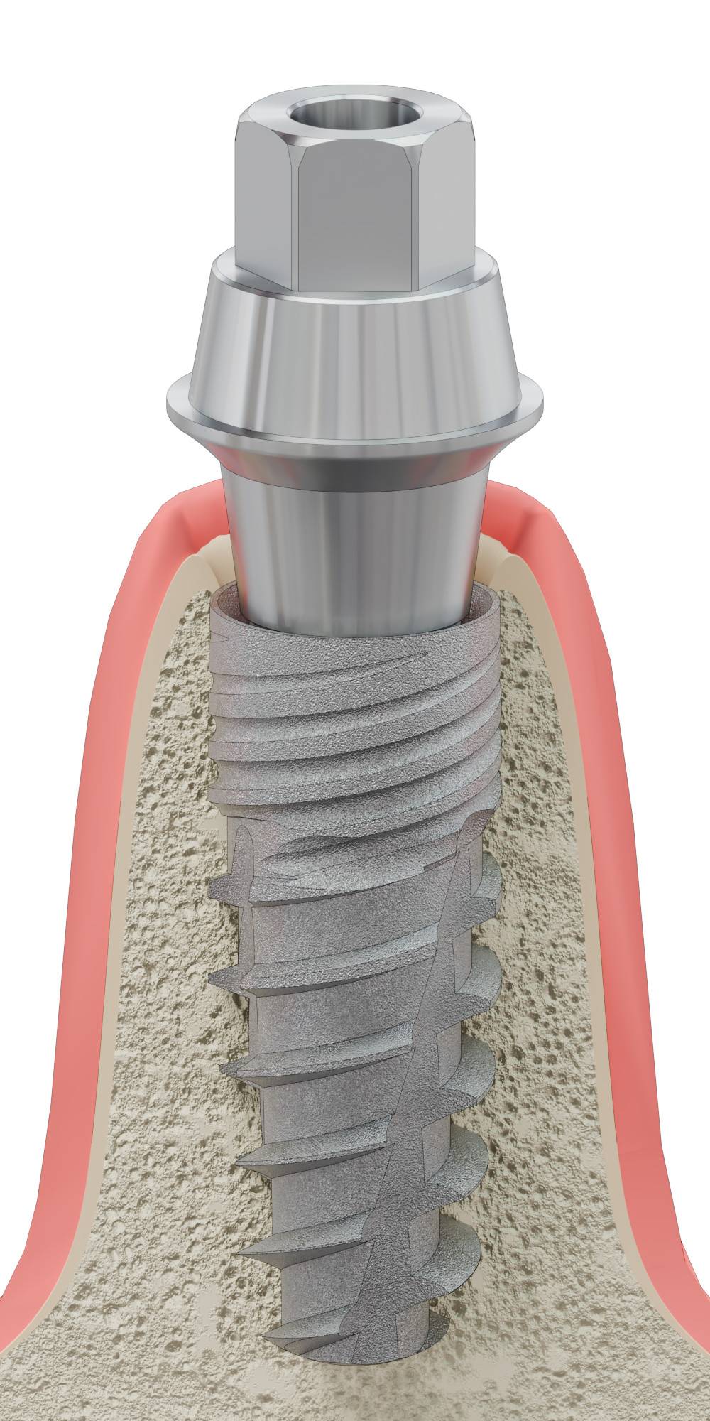 BIOPLANT, Multi-unit SR abutment, with through screw, positioned