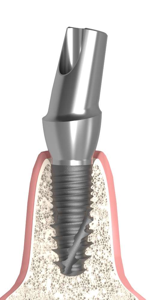 Implant Direct® Replant® (RE) Compatible, Anatomical abutment, oblique