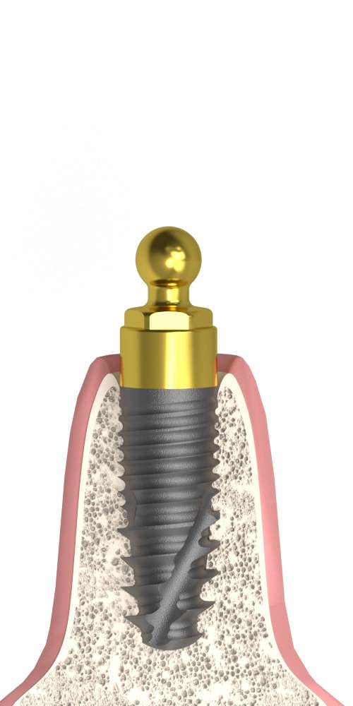 Oralplant® (OR) Compatible, Ball-head OC