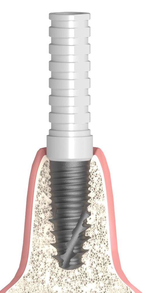 Dentum, Castable plastic abutment, with titan base, implant level