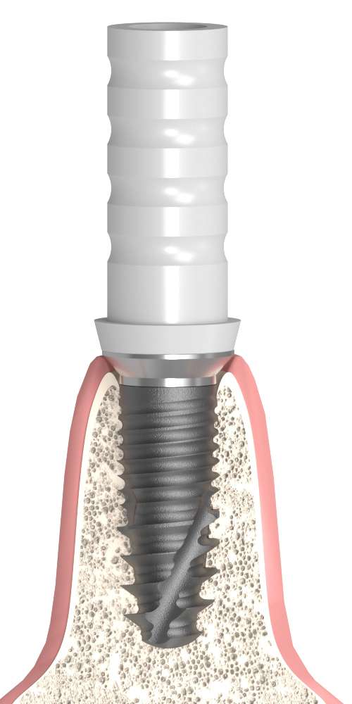 Dentis® (DS) Compatible, Castable plastic abutment, with titan based, implant level, positioned