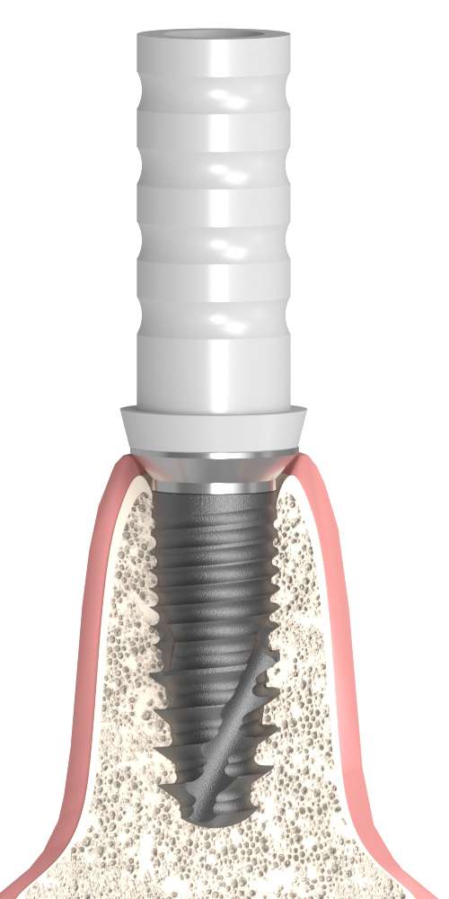 UNIFORM Anonym (unknown brand) (ANONYM) Compatible, Castable plastic abutment, with titan based, implant level, positioned