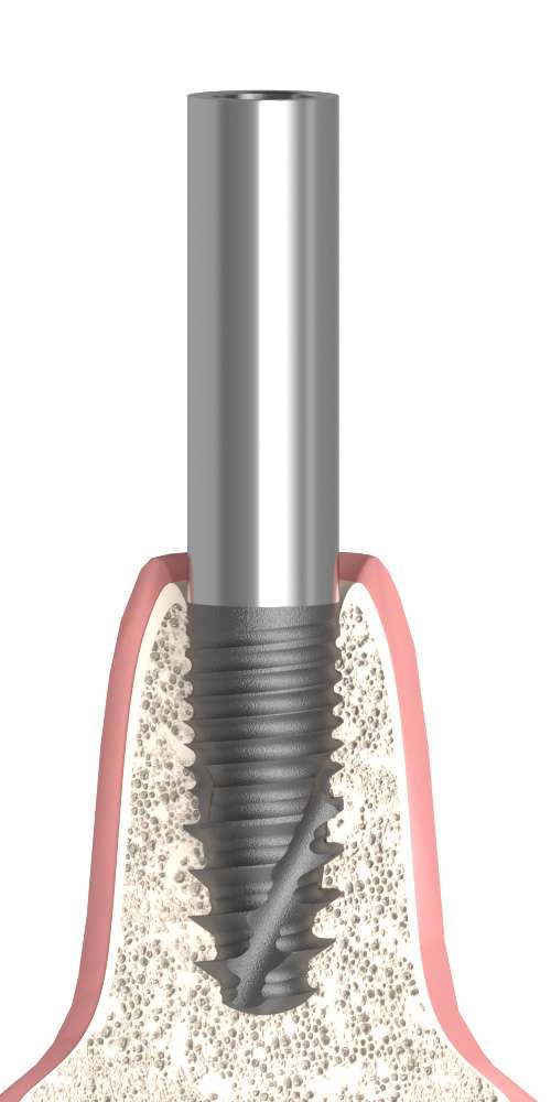 Dentum, Cylindrical abutment
