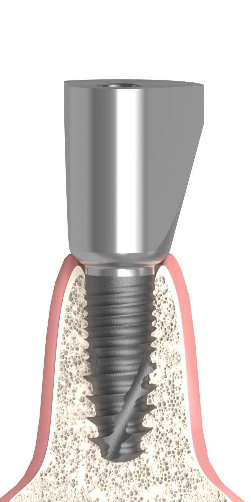Implant Direct® InterActive® (ID) Compatible, Delta abutment, positioned