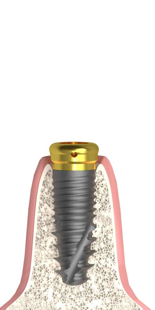 Implant Direct® Replant® (RE) Compatible, Locator abutment + cap set