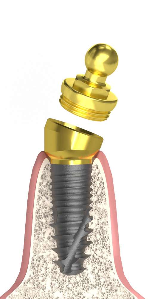 Implant Direct® InterActive® (ID) Compatible, Multi-Compact abutment (MC abutment), oblique, with Ball head