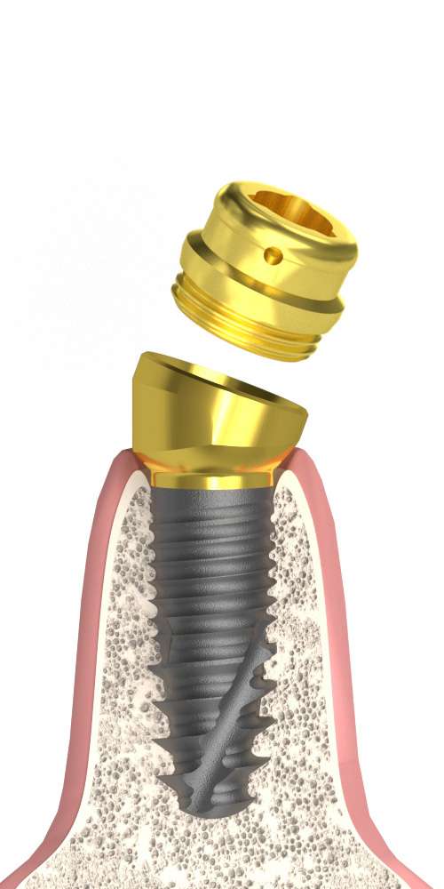 Implant Direct® Replant® (RE) Compatible, Multi-Compact abutment (MC abutment), oblique, with Locator head